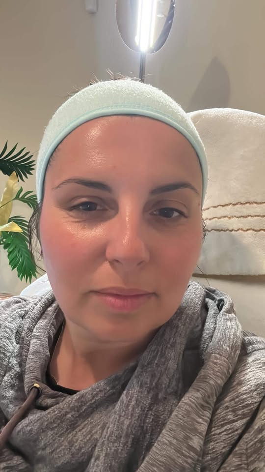 Radio Frequency treatment in Manchester — after result