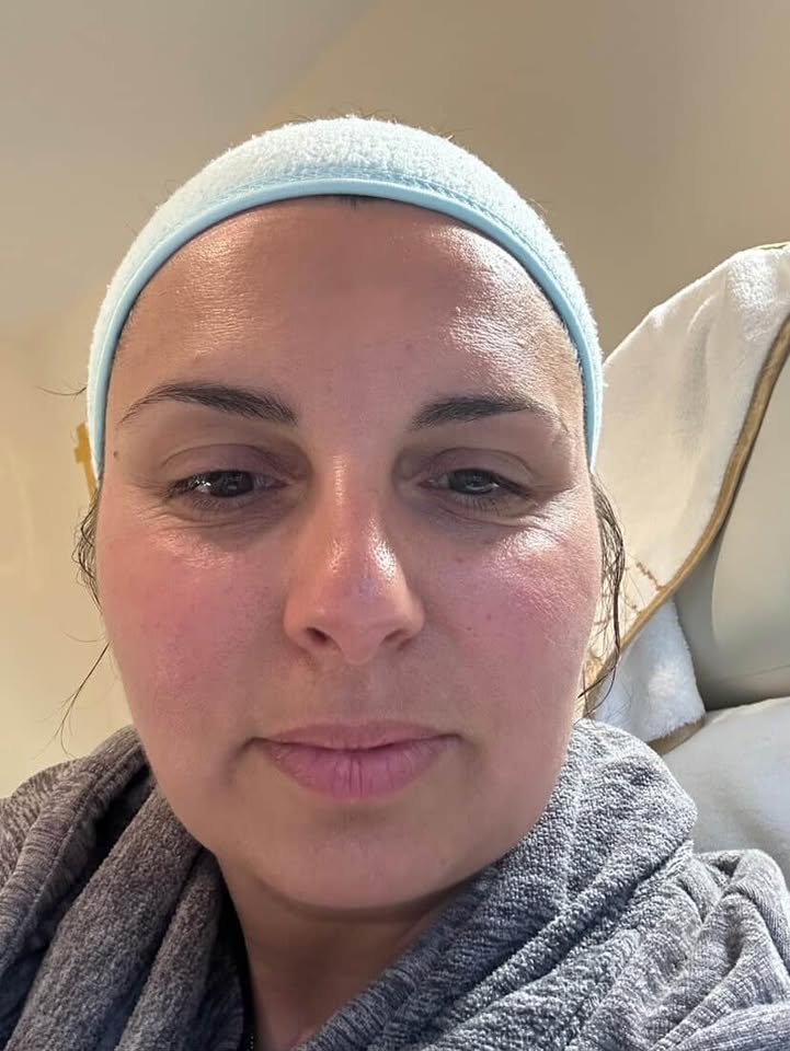 Radio Frequency treatment in Manchester — before result